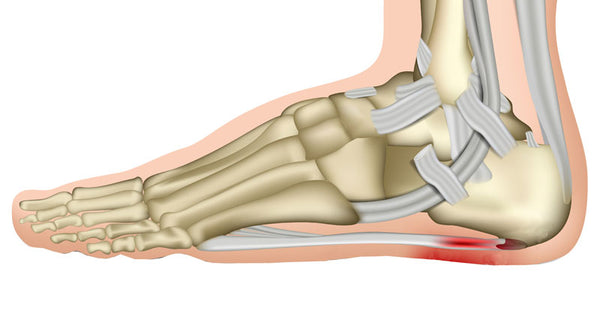 Plantar Fasciitis and How Sorbothane Insoles Help